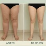 LIPEDEMA