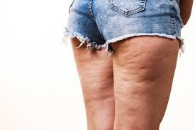 pierna con celulitis celulitis