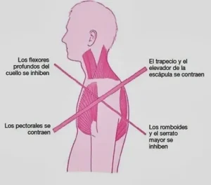 SINDROME DEL CRUZADO SUPERIOR